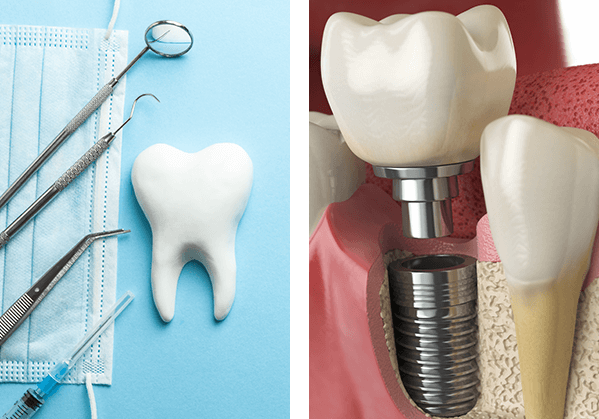 Dental Instrument, Dental Implant Procedure
