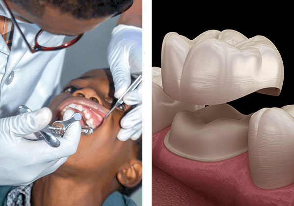 Dentist checking the molar teeth of his patient, Illustration of applying porcelain crown