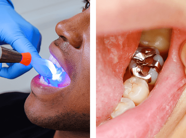 Hand of dentist applying dental fillings on patient, Dental fillings on teeth