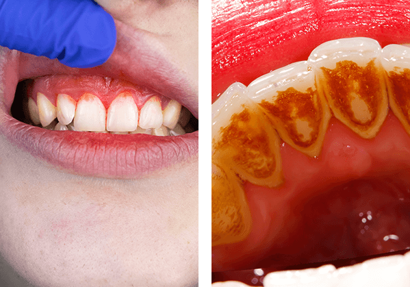 Irritated gums, Too much tartar on teeth