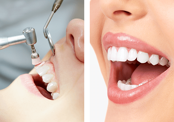 Patient getting her teeth whitened, Dental Instruments, Smiling person
