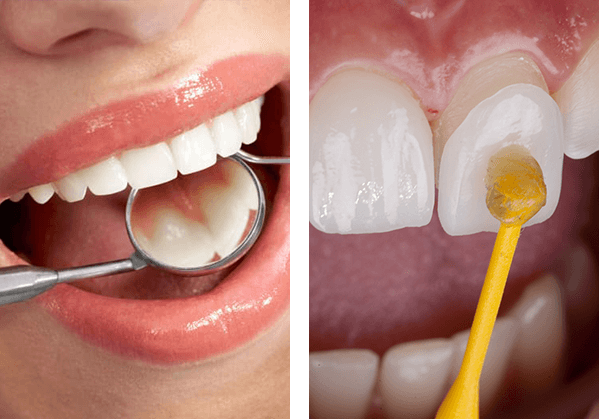 Patient having teeth check using dental instruments, Dental veneer process