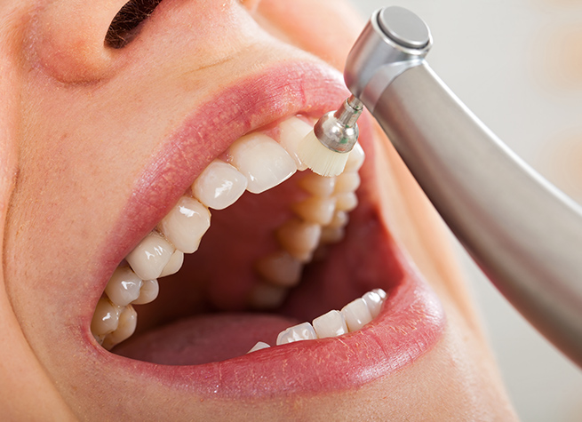 Teeth cleaning process