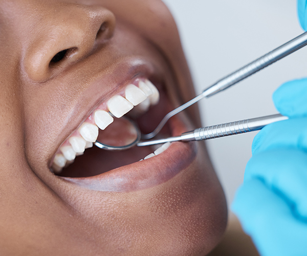 A patient being checkup by the dentist, Dental instrument, Open mouth