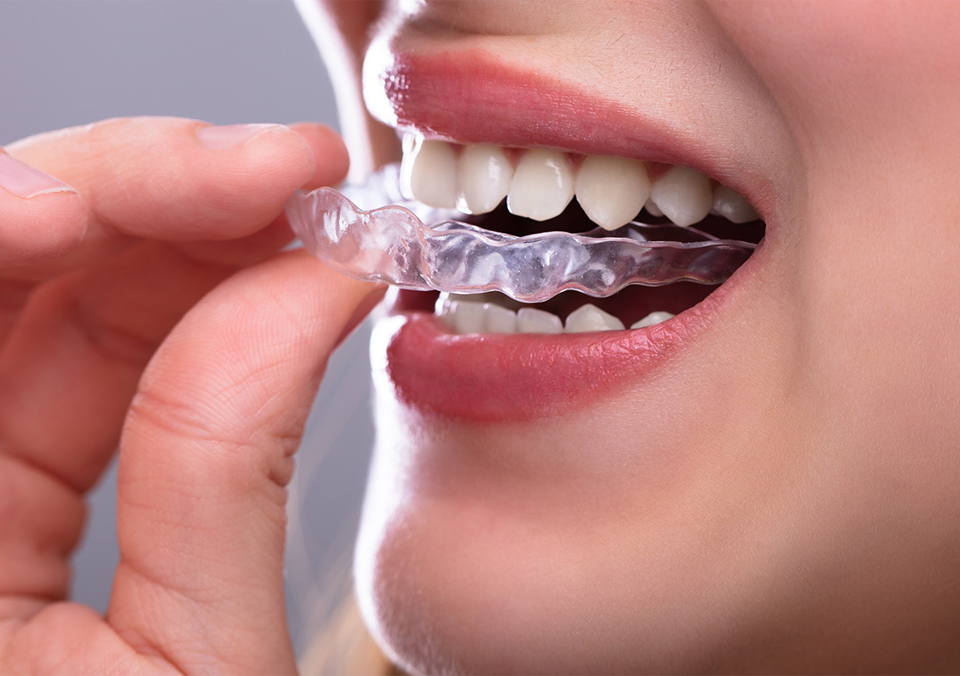 A person that is about to wear a clear mouth guard