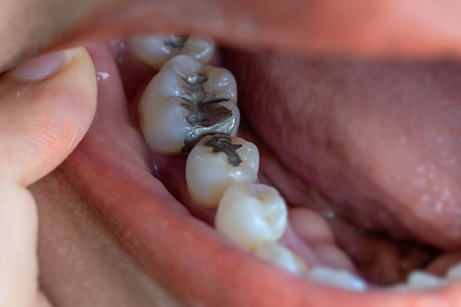 Dental Fillings