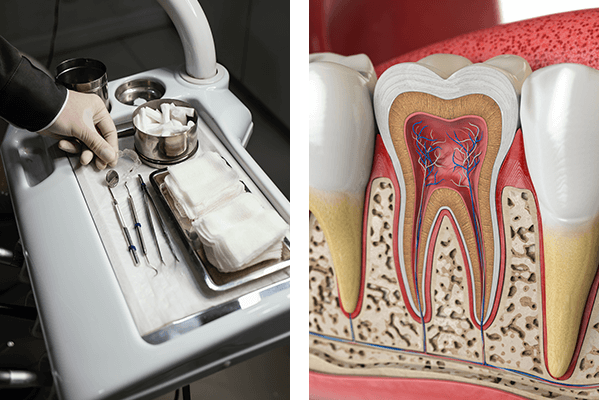 Dental Instruments, Root Canal Illustration
