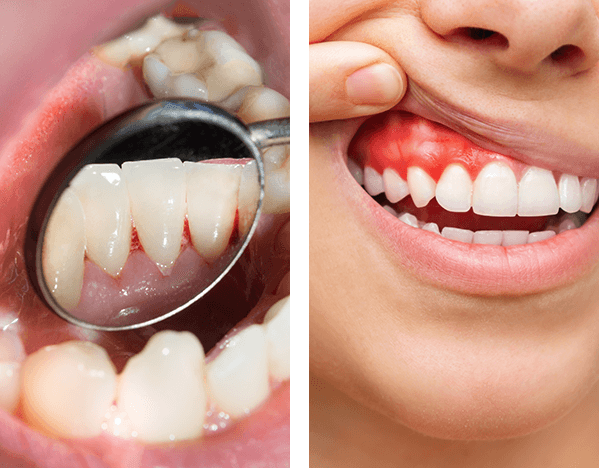 Gum Problems, Reddish Gum, Bleeding Gum