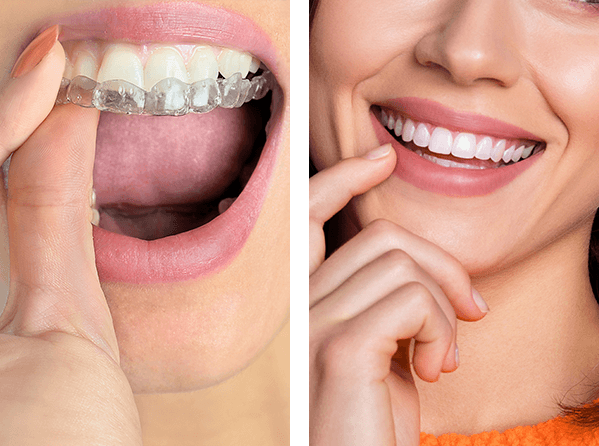 Invisalign, Smiling person