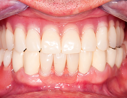 Teeth After Result 01 Teeth After Result