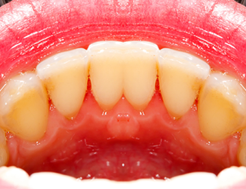 Teeth After Result 02 Teeth After Result