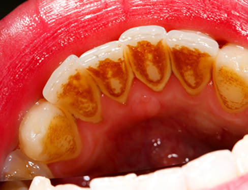 Teeth Before 02 Teeth Before