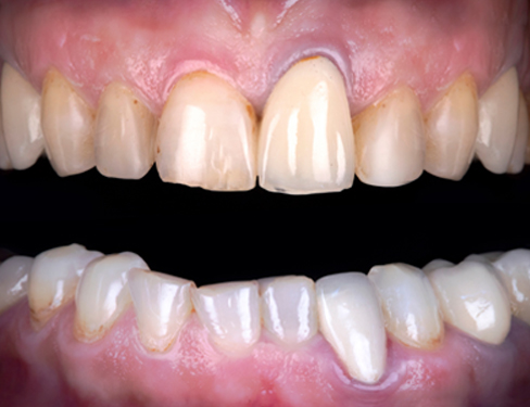 Teeth Before 03 Teeth Before